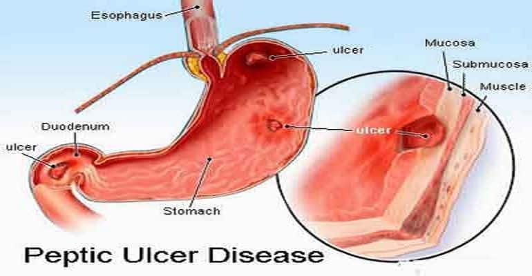 peptic-ulcers-1.jpg