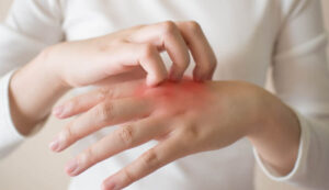 ما هي الأكزيما؟