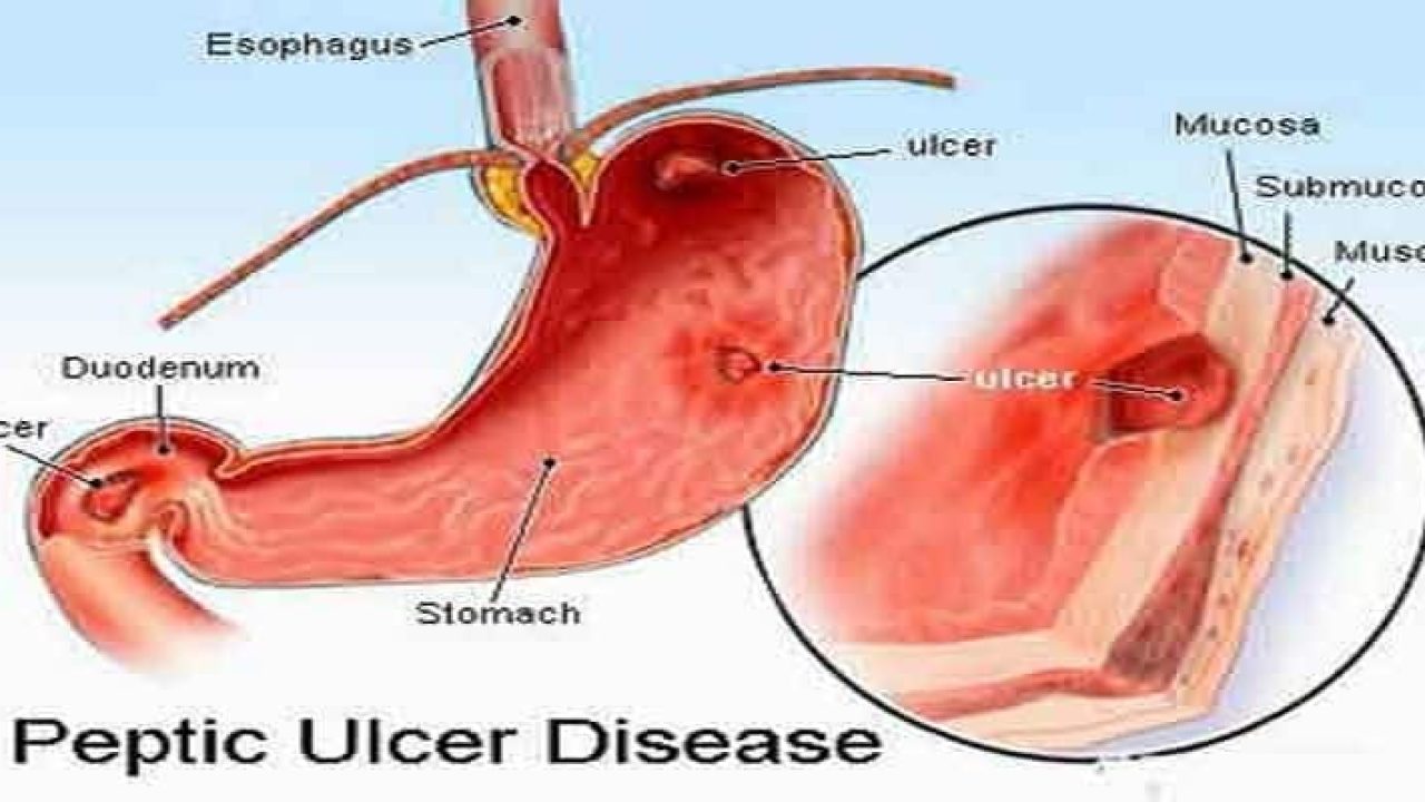 peptic-ulcers-1